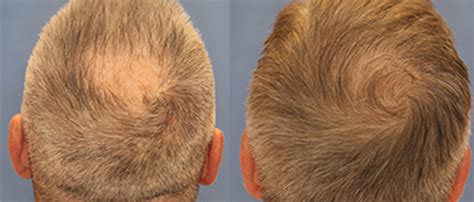 hair transplant st louis|St. Louis Medical Hair Transplants .